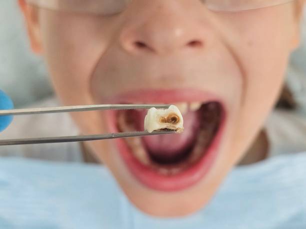 Best Urgent Care for Lost Fillings or Crowns in Horseshoe Bend, AR